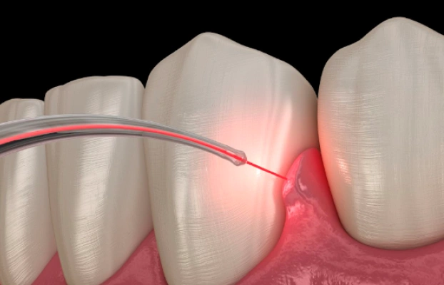 Laser Bacterial Reduction